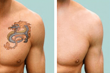 JHB Tattoo Removal